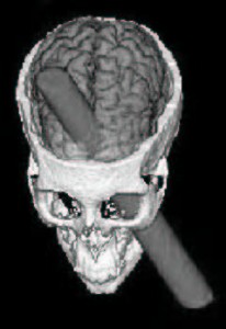 A public domain image showing the path followed by the iron rod that pierced Gage's brain, destroying a large part of his frontal lobe.